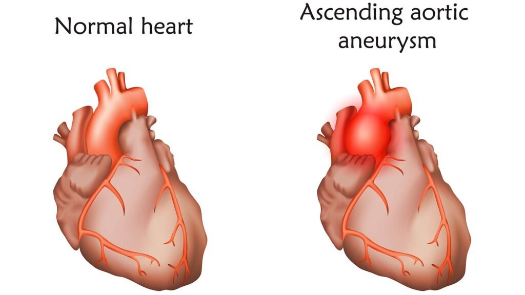 ascending aortic aneurysm