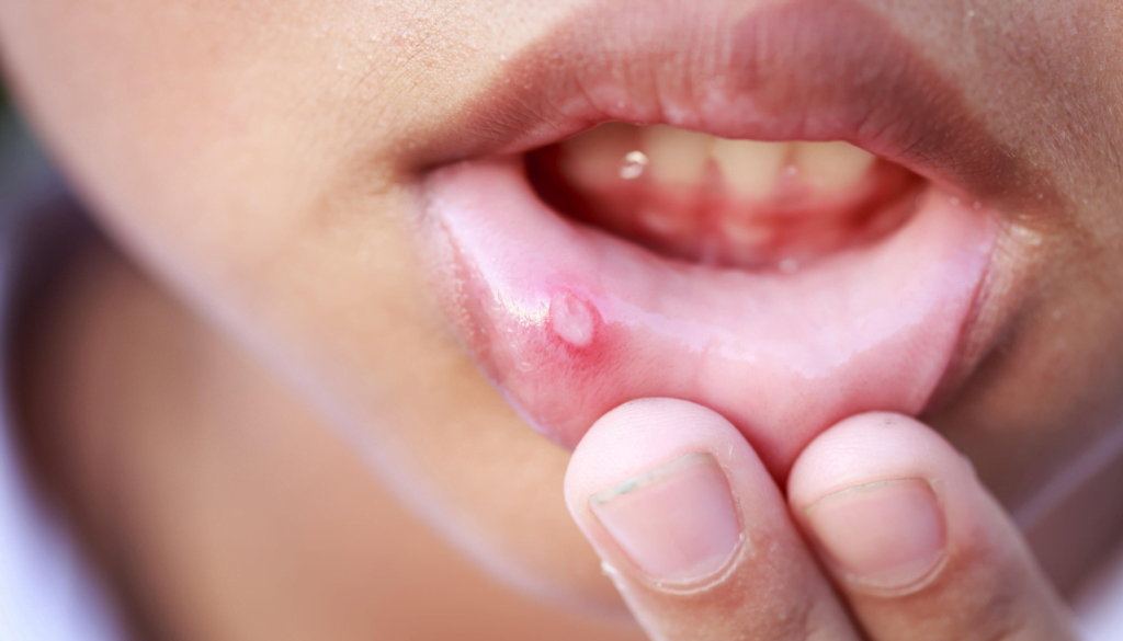 Effective Home Remedies for Mouth Ulcers You Need to Know