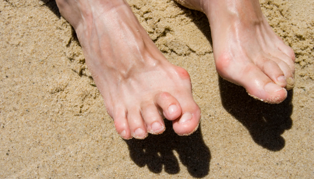 Managing Hammertoes: Tips for Relief and Long-term Care