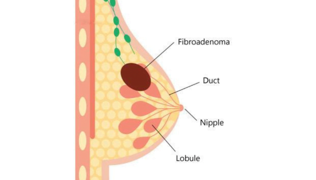 Complete Guide to Fibroadenoma: Diagnosis and Treatment