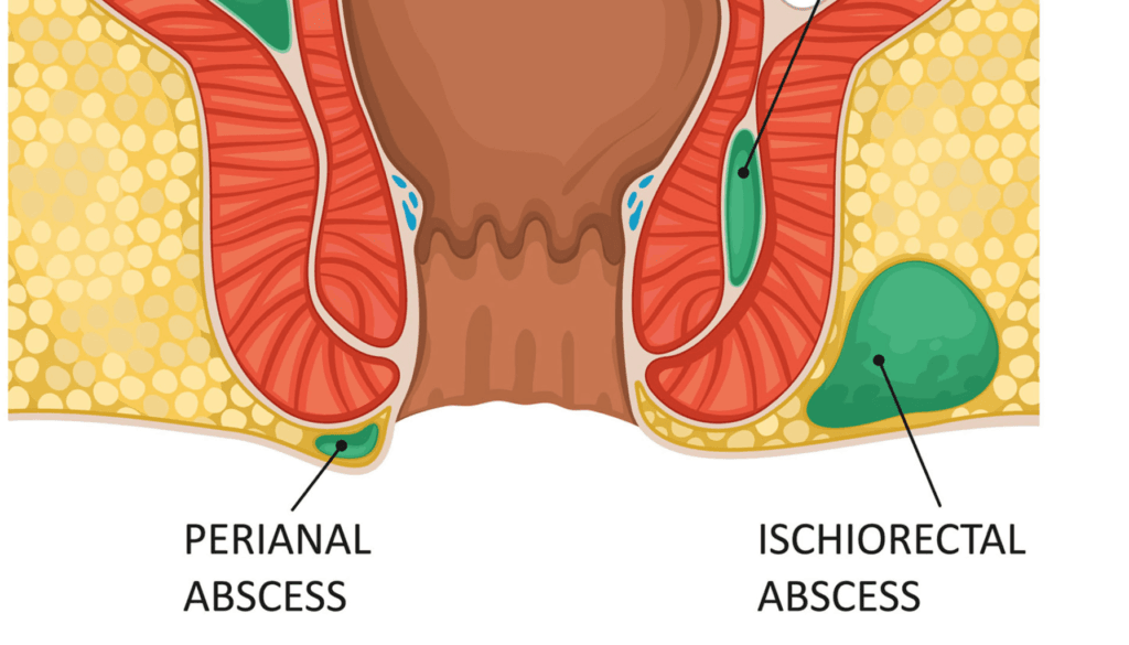 Understanding Perianal Infection: Symptoms, Causes, and Treatment